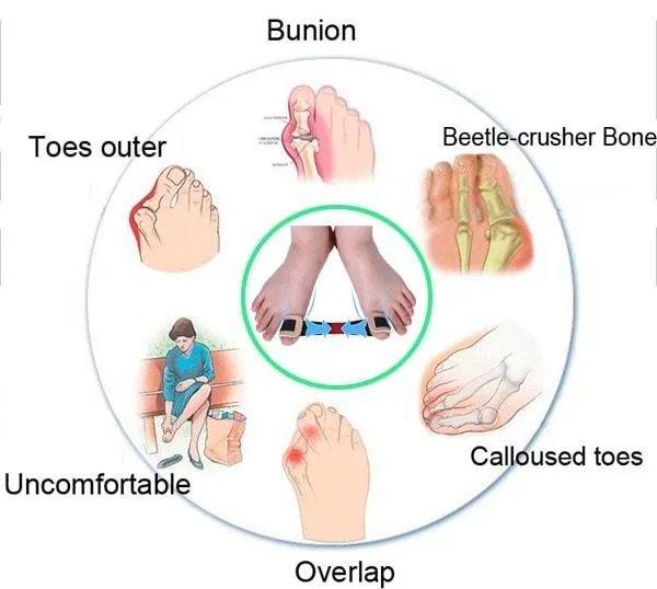 Hallux Valgus Toe Stretcher